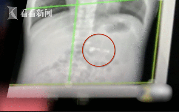 荡气回肠?7岁男孩误吞AirPod医生建议自行排出