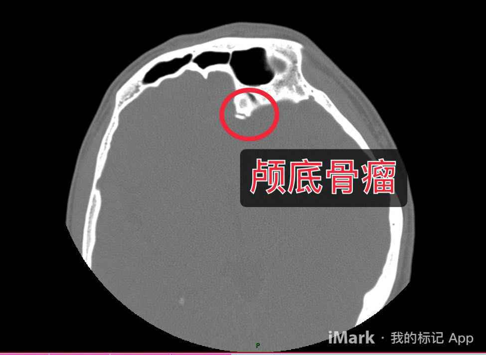 脑子“进气”了，原来祸首是“石头”，神经外科成功治愈一例罕见自发性气颅患者