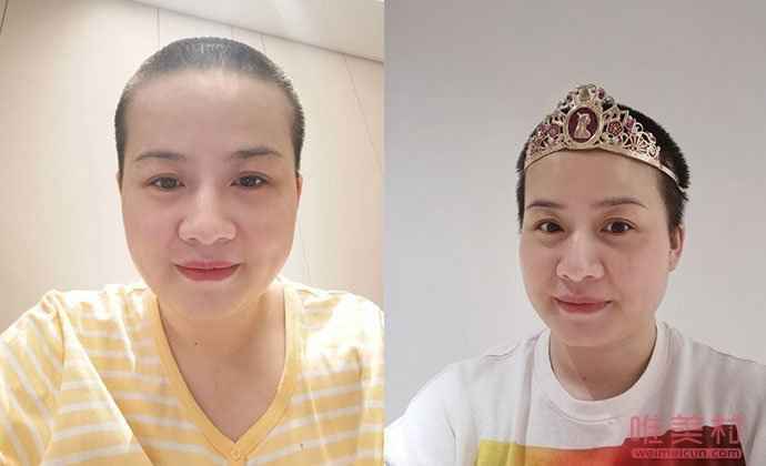 岳云鹏老婆回应生病剃光头说了什么？岳云鹏老婆得了什么病？